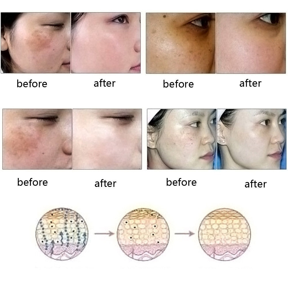 Dredge Meridian Skin Care Natural Pure Removal Acne Stretch Marks Scar Removal Essence oil - Minihomy